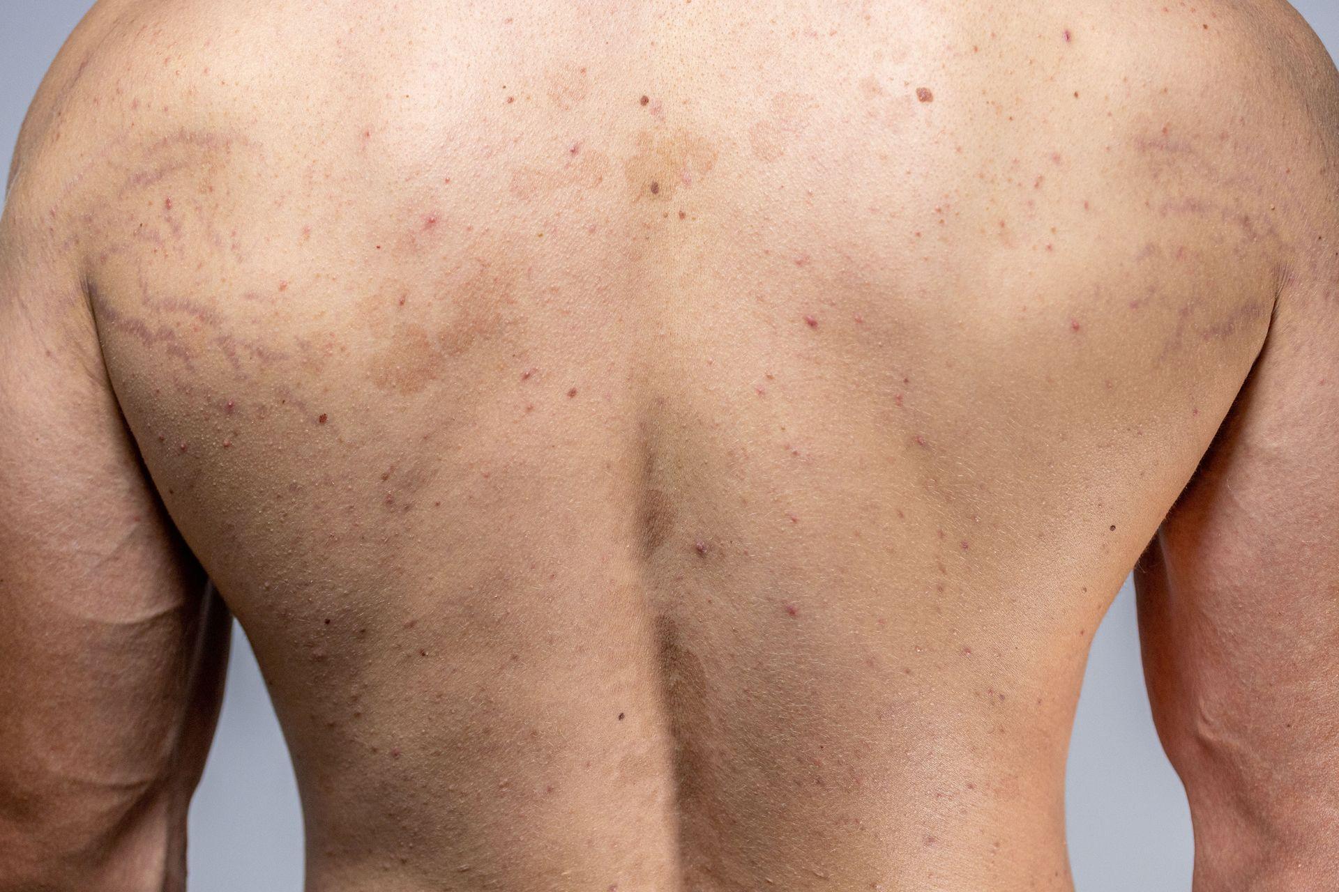 Manchas blancas en la piel o pitiriasis versicolor.