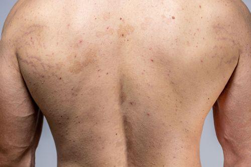 Manchas blancas en la piel o pitiriasis versicolor: qué son y cómo se tratan