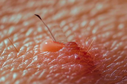 5 trucos sencillos para eliminar pelos enquistados tras la depilación o afeitado