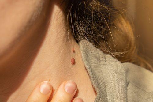 Verrugas: cuándo preocuparse, que tipos existen y qué medidas tomar para evitar su propagación