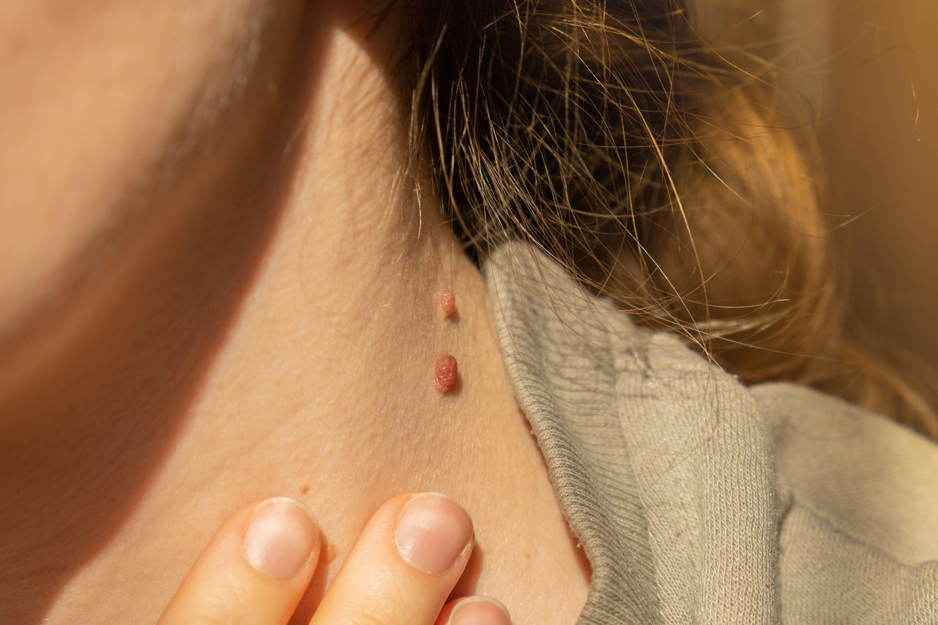 Verruga en el cuello.